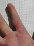 Шишка на суставе пальце после пореза фото 2