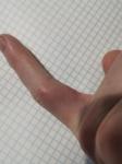 Шишка на суставе пальце после пореза фото 3