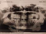Не проходит боль после удаления зуба фото 1