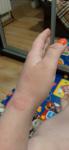 Крассные круглое пятно на руке фото 2