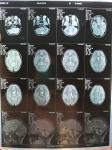 Ретроцеребеллярная арахноидальная киста головного мозга у ребенка 8 фото 2