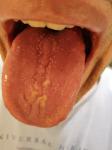 Воспаление слизистой языка, потеря вкуса, набухшие сосочки фото 2