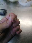 Гангрена пальца руки фото 1