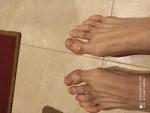 Наросты на косточках пальцев ног, как мазоли или экзема фото 1