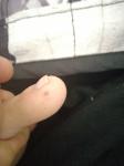 Чёрный прыщ на пальце ноги фото 1