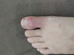 Покраснение большого пальца ноги фото 1