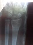 Отёк и боль после перелома лучевой кости длительное время фото 2