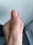 Опух сустав большого пальца руки фото 1