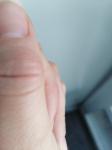Опух сустав большого пальца руки фото 2