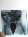 Рентген признаки дисплазии фото 2