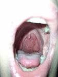 Рак горла, лимфоленопатия фото 3