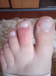 Зуд и покраснение, уплотнение кожи пальца левой ноги, фото 1
