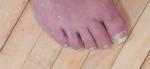 Умеренный отёк и покраснение одного пальца ноги, боль небольшая, дискомфорт фото 1