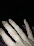 Волдыри на пальцах рук не болят не чешутся фото 4