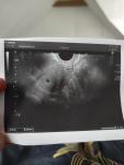 Беременность внематочная фото 1