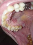 Сыпь во рту после удаления зуба фото 1