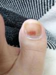 Гематома или меланома под ногтем? фото 1