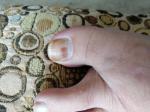 Гематома или меланома под ногтем? фото 3