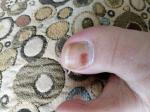 Гематома или меланома под ногтем? фото 4