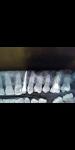 Воспаление киста зуба фото 4