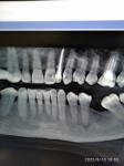 Воспаление киста зуба фото 1