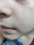 Сыпь бесцветная у ребёнка на лице фото 2
