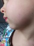 Шелущащееся пятнышко на лице ребенка фото 1