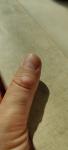 Красный уплотнения на сгибах пальцев руки фото 2