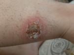 Рана не заживает на ноге после укуса комара фото 1