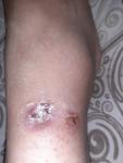 Рана не заживает на ноге после укуса комара фото 2