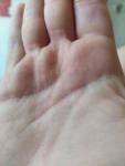 Мелкая сыпь между пальцев ладони с распространением фото 1