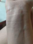 Мелкая сыпь между пальцев ладони с распространением фото 2