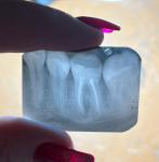 Перелом зуба фото 1