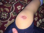 Раны болячки на теле у ребёнка фото 3