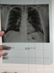 Патологии при рентгене лёгких фото 2