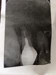 Возможность лечения зуба с коронкой фото 1