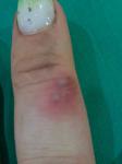 Воспаление на участке кожи пальца фото 1