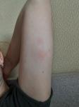 Опухшие красные пятна на теле, аллергия фото 1