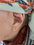 Шишка на ухе у пожилой женщины фото 1