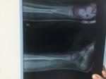 Перелом большеберцовой кости со смещением у ребёнка фото 1