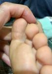 Белые точки на пятке и пальцах ноги фото 2