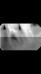 Трещина зуба, гранулема фото 1