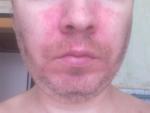 Помогите аллергия на лице мучает 3 года фото 1