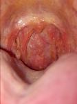 Сухой кашель и белые шишки в горле фото 1