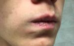 Темнеют уголки губ. Небольшие потемнения. Около 6 месяцев фото 1