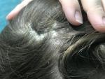 Псориаз волосистости части головы фото 2