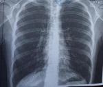 Рентген лёгких, чувство нехватки воздуха фото 2