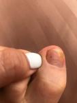 Яркое пятное под ногтем пальца большой ноги фото 1
