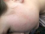 Шелушащиеся пятна на лице у подростка фото 1