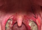 Язвочка на горле после тонзиллэктомии фото 1